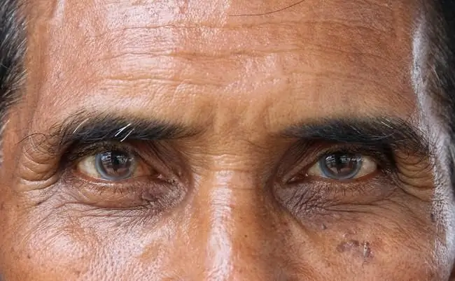 Катаракта у пожилых людей - Alodokter