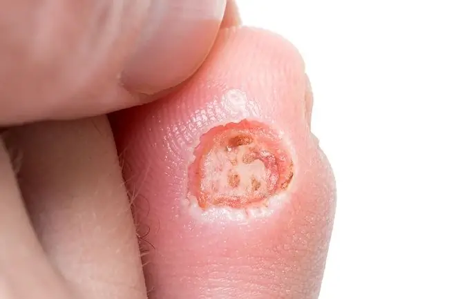 Кальциноз кожи - Alodokter