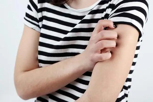 Мастоцитоз - Симптомы, причины и лечение