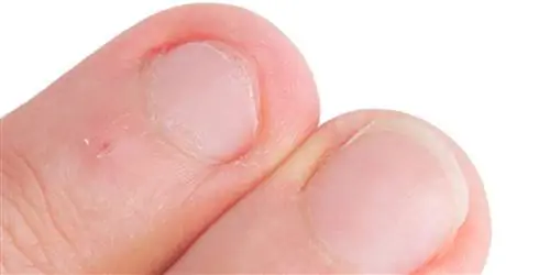 Ломкие ногти не всегда являются постоянным симптомом