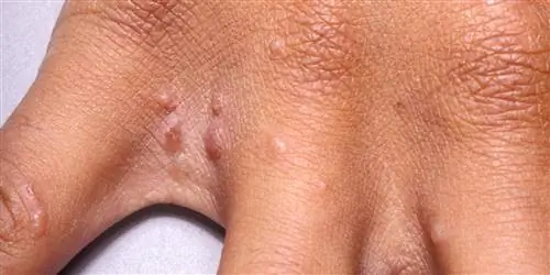 Как лечить чесотку у детей?