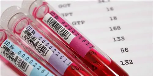 Анемия – диагностируется по анализу крови