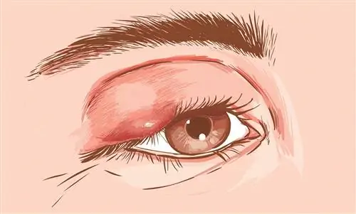 Что такое абсцесс и как его лечить?