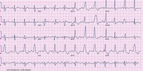 Как диагностируется сердечная аритмия?