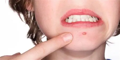 Что вызывает появление бородавок?