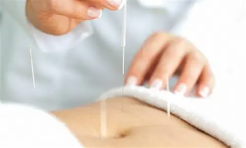 Сильная менструальная боль? Вот как помогает иглоукалывание