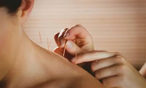 Акупунктура при беременности: как это работает