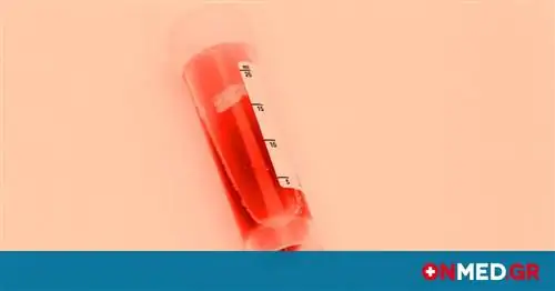 Кровь в моче: все возможные причины в картинках