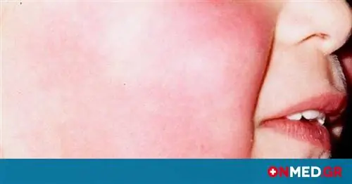 Инфекционная эритема или 5-я болезнь: Симптомы детской болезни (фото)