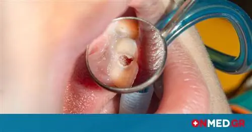 Кариес: 7 продуктов для меньшего количества пломб (изображения)