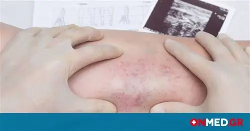 Тромбофлебит: основные факторы риска опасного для жизни состояния (фото)