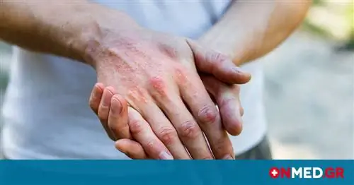 Всемирный день борьбы с атопическим дерматитом: Санофи & Регенерон поддерживает пациентов