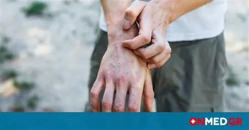 Использование лекарств от псориаза снижается