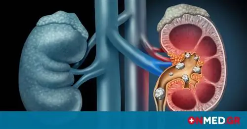 Камни в почках: что есть в праздники, чтобы избежать проблем