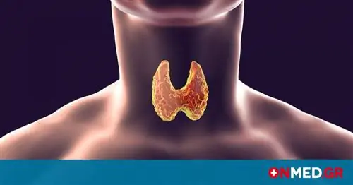 Когда следует удалять щитовидную железу