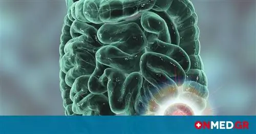 Рак толстой кишки: секрет питания для его эффективного лечения