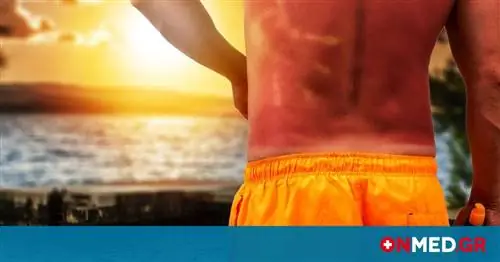 Солнечный ожог: остерегайтесь 5 факторов, которые могут усугубить ситуацию