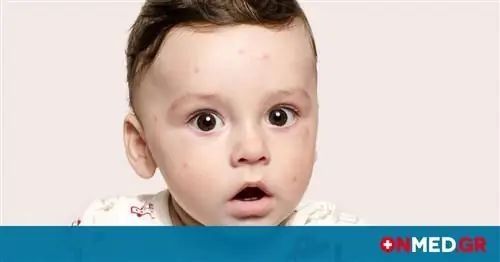 Часто задаваемые вопросы & ответы о кори