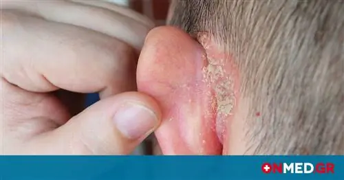 Псориаз: мифы и правда, которые вы должны знать