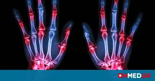 Боль в суставах: 6 тревожных причин