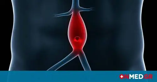 Аневризма брюшной аорты: все, что вам нужно знать