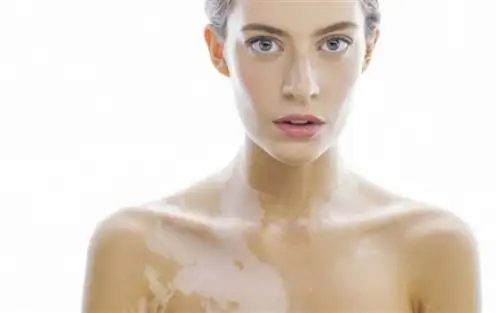 Витилиго: почему на коже образуются белые пятна