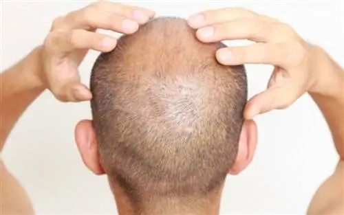 Очаговая алопеция: Когда выпадение волос вызвано аутоиммунным заболеванием - какие есть решения