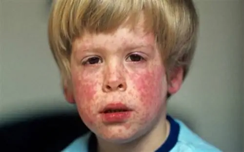 Скарлатина: как распространяется и чем очень опасна для беременных