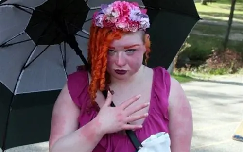 25-летний мужчина с «синдромом Burning Man» (pics&vid)