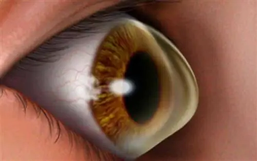 Кератоконус: кто больше всего подвержен риску заболевания глаз?