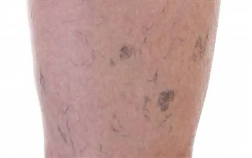 Флебит: как снять отечность и усталость ног