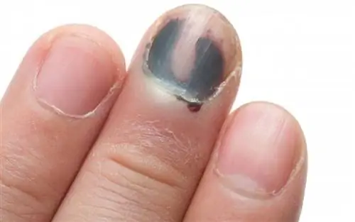 Подногтевая гематома: когда возникает и какие осложнения