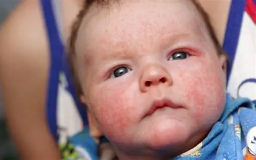 Периоральный дерматит: причины, симптомы, лечение