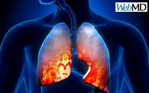 SOS: Признаки того, что у вас пневмония