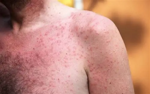 Дерматит: Причины и лечение высыпаний