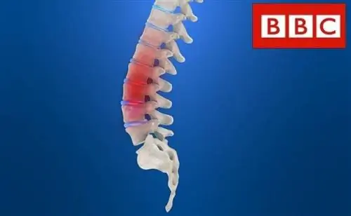 Инновация в лечении сколиоза магнитными стержнями