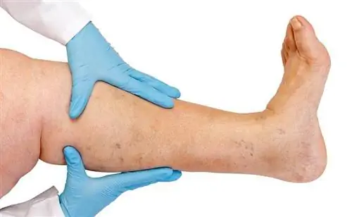 Заболевание вен: смертельный исход для 50 000 греков