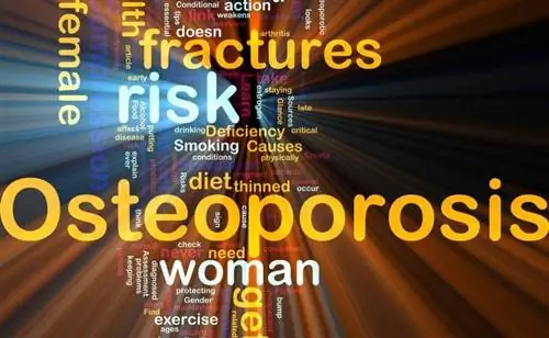 Остеопороз: 9 вопросов и ответов
