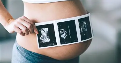 Тесты НИПТ выявляют серьезные аномалии развития плода. Когда стоит делать тест?