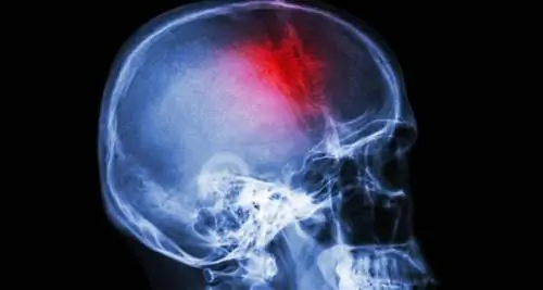 Как снизить риск инсульта?