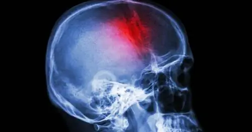 Восемь способов снизить риск инсульта