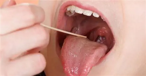 Паратонзиллярный абсцесс - причины, симптомы и лечение инфильтрата