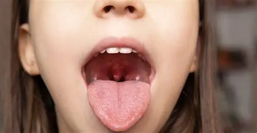 Тонзиллит - все, что вам нужно знать