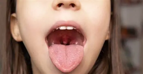 Тонзиллит - симптомы, виды, лечение. Домашние средства от тонзиллита