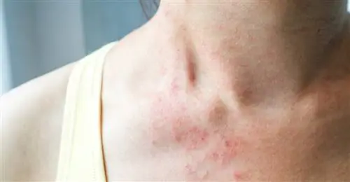 Четыре наиболее распространенных симптома БА