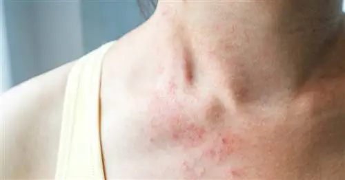 Элоком - состав, действие, показания, дозировка, меры предосторожности