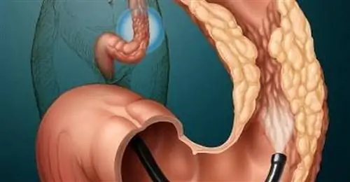 Колоноскопия