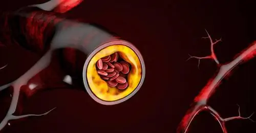 Атеросклероз