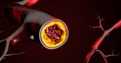 Атеросклероз - причины, профилактика