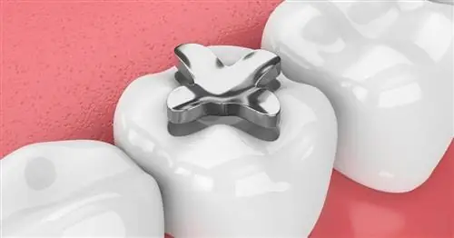 Пломбы из амальгамы – что скрывается в наших зубах?